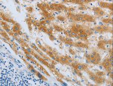 CHRNA7 Antibody - Immunohistochemistry of paraffin-embedded Human liver cancer using CHRFAM7A Polyclonal Antibody at dilution of 1:40.