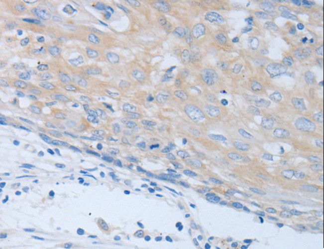 CHRNA7 Antibody - Immunohistochemistry of paraffin-embedded Human cervical cancer using CHRFAM7A Polyclonal Antibody at dilution of 1:40.