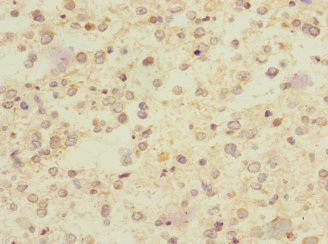 CHRNA9 Antibody - Immunohistochemistry of paraffin-embedded human glioma at dilution 1:100