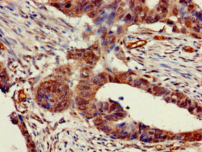 CHRNB1 Antibody - Immunohistochemistry of paraffin-embedded human colon cancer at dilution of 1:100