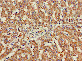 CHRNB1 Antibody - Immunohistochemistry of paraffin-embedded human liver cancer at dilution of 1:100