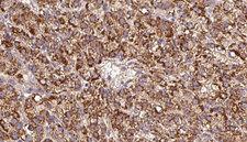 CHRNB3 Antibody - 1:100 staining human liver carcinoma tissues by IHC-P. The sample was formaldehyde fixed and a heat mediated antigen retrieval step in citrate buffer was performed. The sample was then blocked and incubated with the antibody for 1.5 hours at 22°C. An HRP conjugated goat anti-rabbit antibody was used as the secondary.