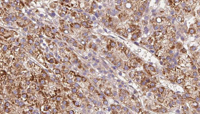CHRNB4 Antibody - 1:100 staining human liver carcinoma tissues by IHC-P. The sample was formaldehyde fixed and a heat mediated antigen retrieval step in citrate buffer was performed. The sample was then blocked and incubated with the antibody for 1.5 hours at 22°C. An HRP conjugated goat anti-rabbit antibody was used as the secondary.