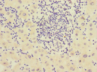 CHRNE Antibody - Immunohistochemistry of paraffin-embedded human liver cancer at dilution 1:100