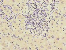 CHRNE Antibody - Immunohistochemistry of paraffin-embedded human liver cancer at dilution 1:100