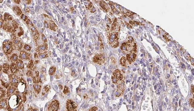 CHRNG Antibody - 1:100 staining human liver carcinoma tissues by IHC-P. The sample was formaldehyde fixed and a heat mediated antigen retrieval step in citrate buffer was performed. The sample was then blocked and incubated with the antibody for 1.5 hours at 22°C. An HRP conjugated goat anti-rabbit antibody was used as the secondary.