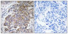 CHST10 Antibody - Immunohistochemistry analysis of paraffin-embedded human lung carcinoma tissue, using CHST10 Antibody. The picture on the right is blocked with the synthesized peptide.