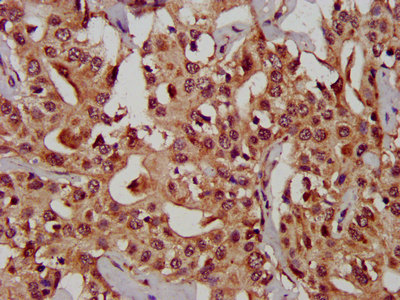 CHST11 Antibody - Immunohistochemistry image at a dilution of 1:300 and staining in paraffin-embedded human liver cancer performed on a Leica BondTM system. After dewaxing and hydration, antigen retrieval was mediated by high pressure in a citrate buffer (pH 6.0) . Section was blocked with 10% normal goat serum 30min at RT. Then primary antibody (1% BSA) was incubated at 4 °C overnight. The primary is detected by a biotinylated secondary antibody and visualized using an HRP conjugated SP system.