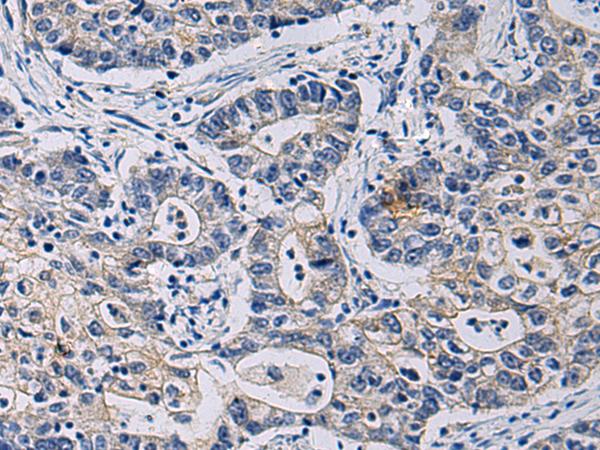 CHST3 Antibody - Immunohistochemistry of paraffin-embedded Human gastric cancer tissue  using CHST3 Polyclonal Antibody at dilution of 1:35(×200)