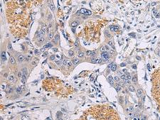 CHST3 Antibody - Immunohistochemistry of paraffin-embedded Human esophagus cancer tissue  using CHST3 Polyclonal Antibody at dilution of 1:30(×200)