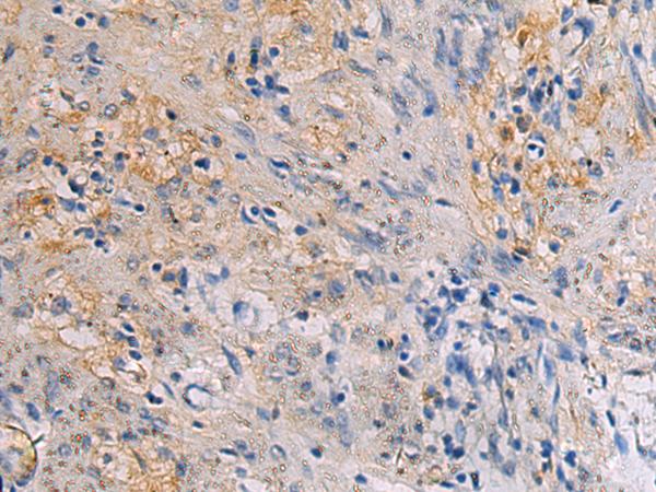 CHST3 Antibody - Immunohistochemistry of paraffin-embedded Human gastric cancer tissue  using CHST3 Polyclonal Antibody at dilution of 1:30(×200)