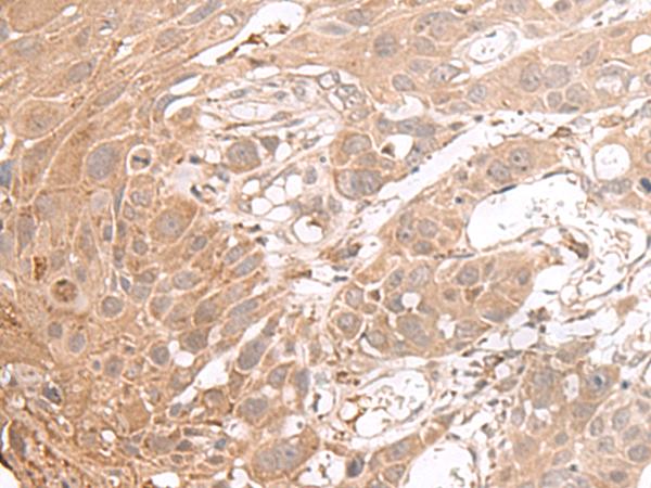 CHST4 / GlcNAc6ST2 Antibody - Immunohistochemistry of paraffin-embedded Human esophagus cancer tissue  using CHST4 Polyclonal Antibody at dilution of 1:35(×200)