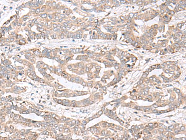 CHST4 / GlcNAc6ST2 Antibody - Immunohistochemistry of paraffin-embedded Human liver cancer tissue  using CHST4 Polyclonal Antibody at dilution of 1:35(×200)