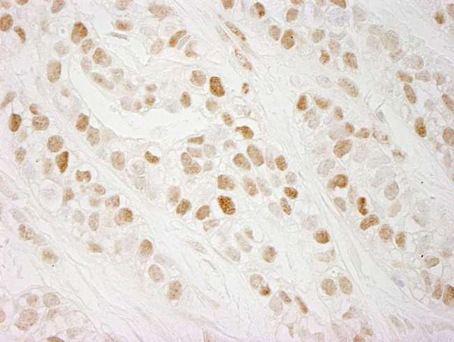 CHTF18 / RUVBL Antibody - Detection of Human CTF18 by Immunohistochemistry. Sample: FFPE section of human breast carcinoma. Antibody: Affinity purified rabbit anti-CTF18 used at a dilution of 1:250.
