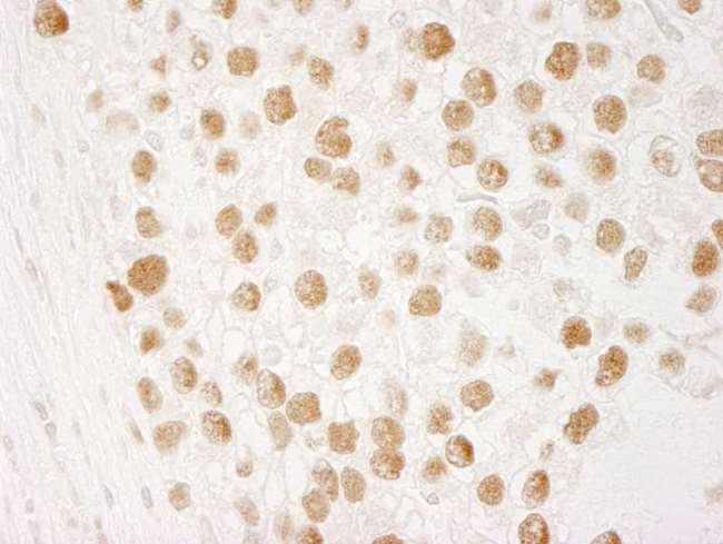CHTF18 / RUVBL Antibody - Detection of Human CTF18 by Immunohistochemistry. Sample: FFPE section of human testicular seminoma. Antibody: Affinity purified rabbit anti-CTF18 used at a dilution of 1:250.
