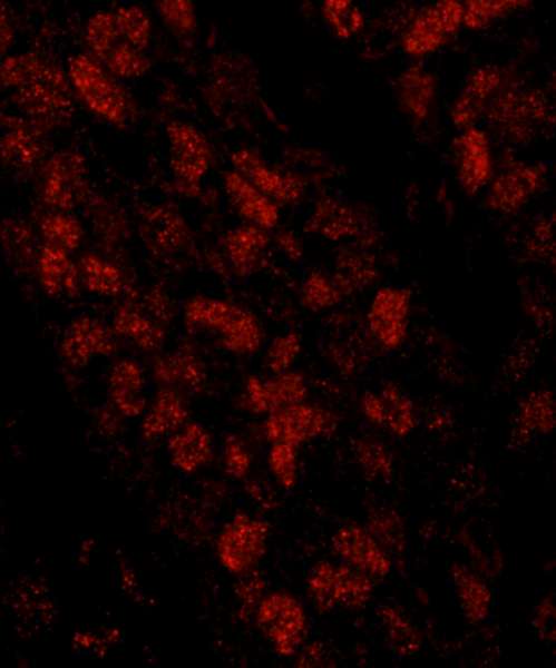 CHTF18 / RUVBL Antibody - Detection of Human CTF18 by Immunohistochemistry. Sample: FFPE section of human breast carcinoma. Antibody: Affinity purified rabbit anti-CTF18 used at a dilution of 1:100. Detection: Red-fluorescent goat anti-rabbit IgG highly cross-adsorbed Antibody used at a dilution of 1:100.