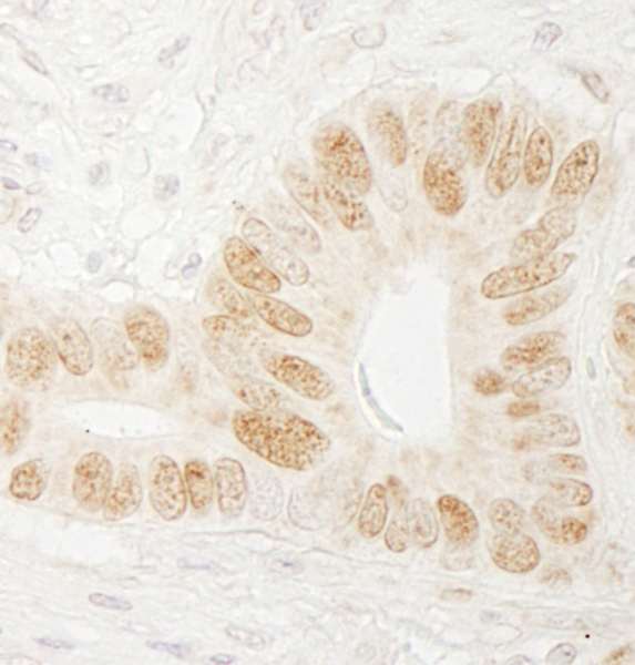 CHTF18 / RUVBL Antibody - Detection of Human CTF18 by Immunohistochemistry. Sample: FFPE section of human stomach carcinoma. Antibody: Affinity purified rabbit anti-CTF18 used at a dilution of 1:200 (1 ug/ml). Detection: DAB.