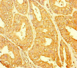 CHTOP / FOP Antibody - Immunohistochemistry of paraffin-embedded human endometrial cancer at dilution of 1:100