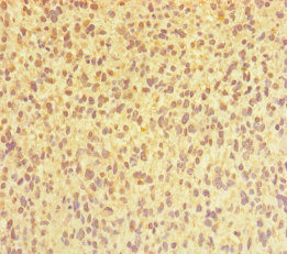 CHTOP / FOP Antibody - Immunohistochemistry of paraffin-embedded human glioma cancer at dilution of 1:100