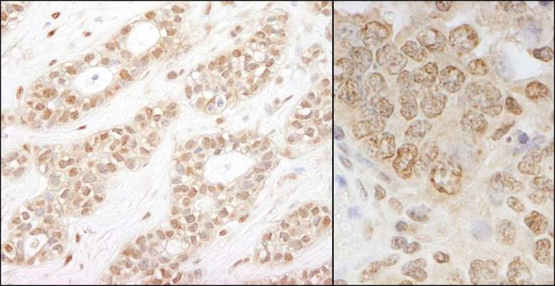 CHUK / IKKA / IKK Alpha Antibody - Detection of Human and Mouse IKK-alpha by Immunohistochemistry. Sample: FFPE section of human breast carcinoma (left) and mouse teratoma (right). Antibody: Affinity purified rabbit anti-IKK-alpha used at a dilution of 1:200 (1 Detection: DAB.