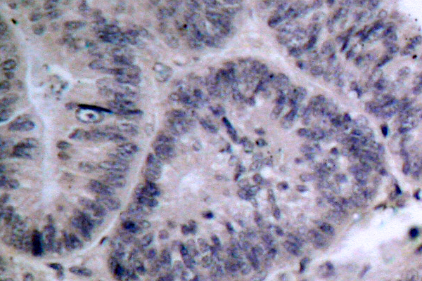 CHUK / IKKA / IKK Alpha Antibody - IHC of IKK- (M17) pAb in paraffin-embedded human colon carcinoma tissue.