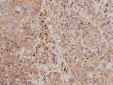 CHUK / IKKA / IKK Alpha Antibody - 1:50 staining human breast carcinoma tissue by IHC-P. The tissue was formaldehyde fixed and a heat mediated antigen retrieval step in citrate buffer was performed. The tissue was then blocked and incubated with the antibody for 1.5 hours at 22°C. An HRP conjugated goat anti-rabbit antibody was used as the secondary.