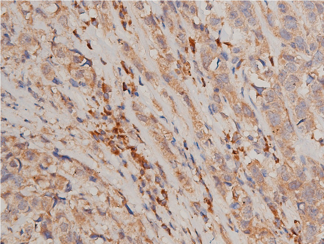 CHUK / IKKA / IKK Alpha Antibody - 1:50 staining human breast carcinoma tissue by IHC-P. The tissue was formaldehyde fixed and a heat mediated antigen retrieval step in citrate buffer was performed. The tissue was then blocked and incubated with the antibody for 1.5 hours at 22°C. An HRP conjugated goat anti-rabbit antibody was used as the secondary.