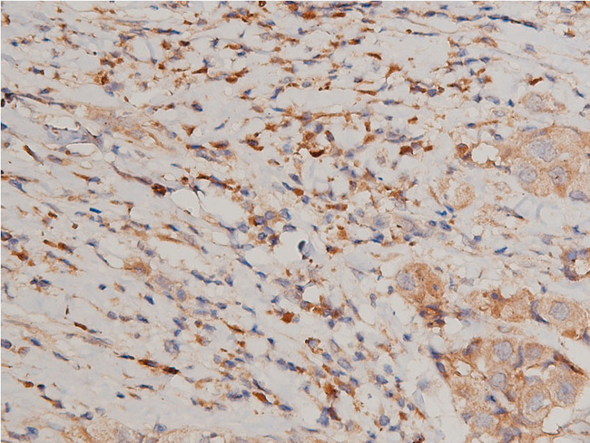 CHUK / IKKA / IKK Alpha Antibody - 1:200 staining human breast carcinoma tissue by IHC-P. The tissue was formaldehyde fixed and a heat mediated antigen retrieval step in citrate buffer was performed. The tissue was then blocked and incubated with the antibody for 1.5 hours at 22°C. An HRP conjugated goat anti-rabbit antibody was used as the secondary.