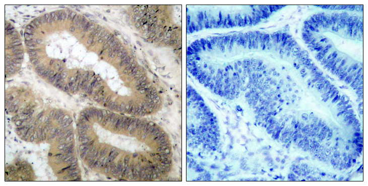 CHUK / IKKA / IKK Alpha Antibody - Immunohistochemistry analysis of paraffin-embedded human colon carcinoma, using IKK-alpha (Phospho-Thr23) Antibody. The picture on the right is blocked with the phospho peptide.