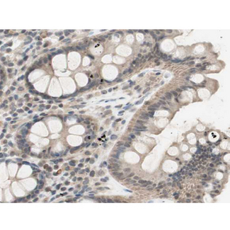 CHUK / IKKA / IKK Alpha Antibody - 1:200 staining human colon carcinoma tissue by IHC-P. The tissue was formaldehyde fixed and a heat mediated antigen retrieval step in citrate buffer was performed. The tissue was then blocked and incubated with the antibody for 1.5 hours at 22°C. An HRP conjugated goat anti-rabbit antibody was used as the secondary.