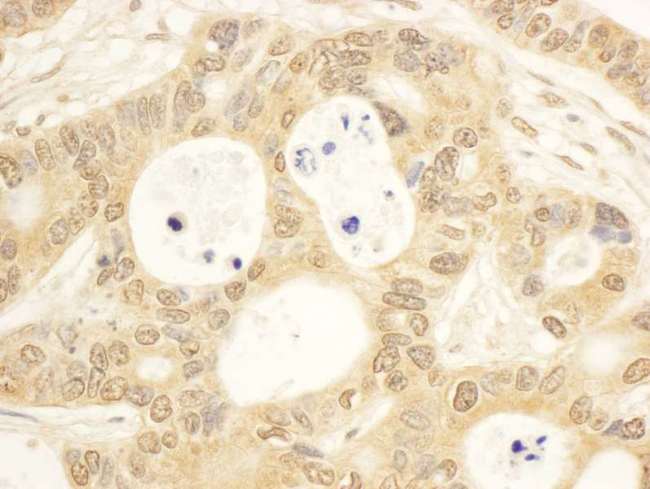CIAPIN1 / Anamorsin Antibody - Detection of Human CIAPIN1 by Immunohistochemistry. Sample: FFPE section of human ovarian carcinoma. Antibody: Affinity purified rabbit anti-CIAPIN1 used at a dilution of 1:1000 (1 ug/ml). Detection: DAB.