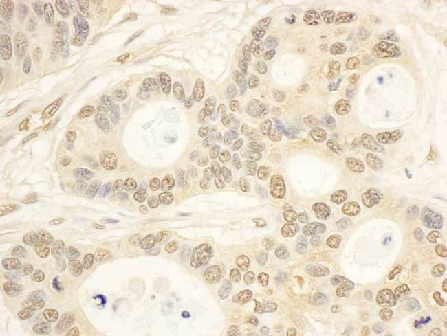 CIAPIN1 / Anamorsin Antibody - Detection of Human CIAPIN1 by Immunohistochemistry. Sample: FFPE section of human ovarian carcinoma. Antibody: Affinity purified rabbit anti-CIAPIN1 used at a dilution of 1:200 (1 ug/ml). Detection: DAB.