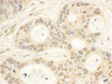 CIAPIN1 / Anamorsin Antibody - Detection of Human CIAPIN1 by Immunohistochemistry. Sample: FFPE section of human ovarian carcinoma. Antibody: Affinity purified rabbit anti-CIAPIN1 used at a dilution of 1:200 (1 ug/ml). Detection: DAB.