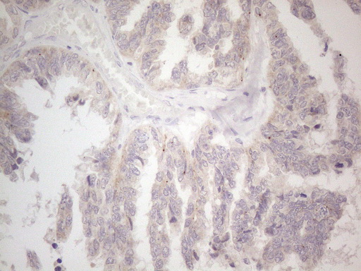 CIAPIN1 / Anamorsin Antibody - Immunohistochemical staining of paraffin-embedded Adenocarcinoma of Human ovary tissue using anti-CIAPIN1 mouse monoclonal antibody. (Heat-induced epitope retrieval by 1mM EDTA in 10mM Tris buffer. (pH8.5) at 120°C for 3 min. (1:150)