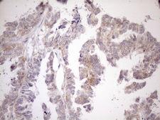 CIAPIN1 / Anamorsin Antibody - Immunohistochemical staining of paraffin-embedded Adenocarcinoma of Human ovary tissue using anti-CIAPIN1 mouse monoclonal antibody. (Heat-induced epitope retrieval by 1mM EDTA in 10mM Tris buffer. (pH8.5) at 120°C for 3 min. (1:150)