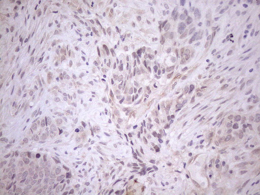CIAPIN1 / Anamorsin Antibody - Immunohistochemical staining of paraffin-embedded Adenocarcinoma of Human endometrium tissue using anti-CIAPIN1 mouse monoclonal antibody. (Heat-induced epitope retrieval by 1mM EDTA in 10mM Tris buffer. (pH8.5) at 120°C for 3 min. (1:150)