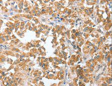CIAPIN1 / Anamorsin Antibody - Immunohistochemistry of paraffin-embedded Human liver cancer using CIAPIN1 Polyclonal Antibody at dilution of 1:60.