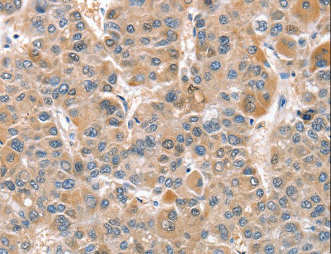 CIAPIN1 / Anamorsin Antibody - Immunohistochemistry of paraffin-embedded Human liver cancer using CIAPIN1 Polyclonal Antibody at dilution of 1:60.