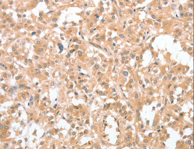 CIAPIN1 / Anamorsin Antibody - Immunohistochemistry of paraffin-embedded Human thyroid cancer using CIAPIN1 Polyclonal Antibody at dilution of 1:60.