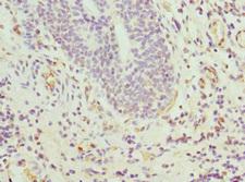 CIAPIN1 / Anamorsin Antibody - Immunohistochemistry of paraffin-embedded human bladder cancer at dilution 1:100