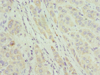 CIAPIN1 / Anamorsin Antibody - Immunohistochemistry of paraffin-embedded human liver cancer at dilution 1:100