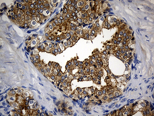 CIB1 / KIP Antibody - Immunohistochemical staining of paraffin-embedded Carcinoma of Human prostate tissue using anti-CIB1 mouse monoclonal antibody. (Heat-induced epitope retrieval by 1mM EDTA in 10mM Tris buffer. (pH8.5) at 120°C for 3 min. (1:500)