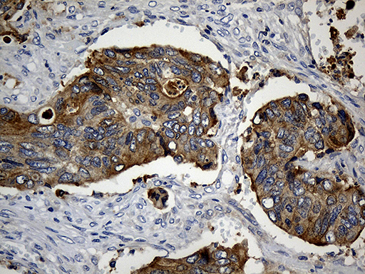 CIB1 / KIP Antibody - Immunohistochemical staining of paraffin-embedded Adenocarcinoma of Human colon tissue using anti-CIB1 mouse monoclonal antibody. (Heat-induced epitope retrieval by 1mM EDTA in 10mM Tris buffer. (pH8.5) at 120°C for 3 min. (1:500)