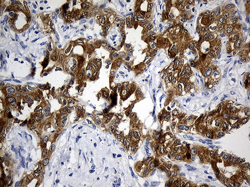 CIB1 / KIP Antibody - Immunohistochemical staining of paraffin-embedded Carcinoma of Human liver tissue using anti-CIB1 mouse monoclonal antibody. (Heat-induced epitope retrieval by 1mM EDTA in 10mM Tris buffer. (pH8.5) at 120°C for 3 min. (1:500)