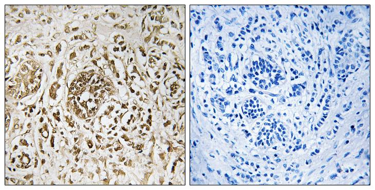 CIB2 / KIP2 Antibody - Peptide - + Immunohistochemistry analysis of paraffin-embedded human breast carcinoma tissue, using CIB2 antibody.