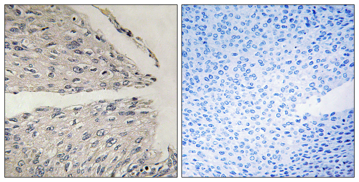 CIDEB Antibody - Immunohistochemistry analysis of paraffin-embedded human cervix caecinoma tissue, using CIDEB Antibody. The picture on the right is blocked with the synthesized peptide.