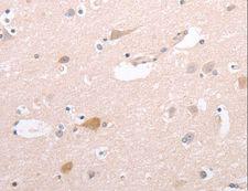 CIDEB Antibody - Immunohistochemistry of paraffin-embedded Human cervical cancer using CIDEB Polyclonal Antibody at dilution of 1:50.