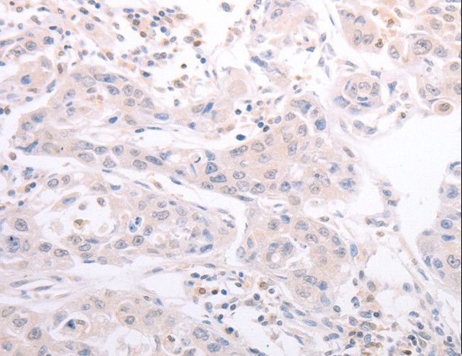 CIDEB Antibody - Immunohistochemistry of paraffin-embedded Human lung cancer using CIDEB Polyclonal Antibody at dilution of 1:50.