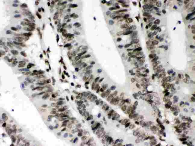 CIITA Antibody - CIITA was detected in paraffin-embedded sections of human intestinal cancer tissues using rabbit anti- CIITA Antigen Affinity purified polyclonal antibody