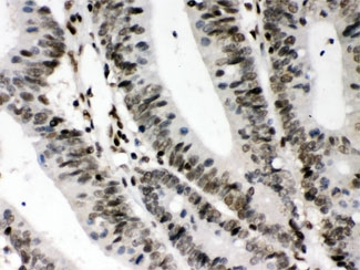 CIITA Antibody - IHC testing of FFPE human intestine cancer tissue with CIITA antibody at 1ug/ml. HIER: steam in pH6 citrate buffer and allow to cool prior to staining.